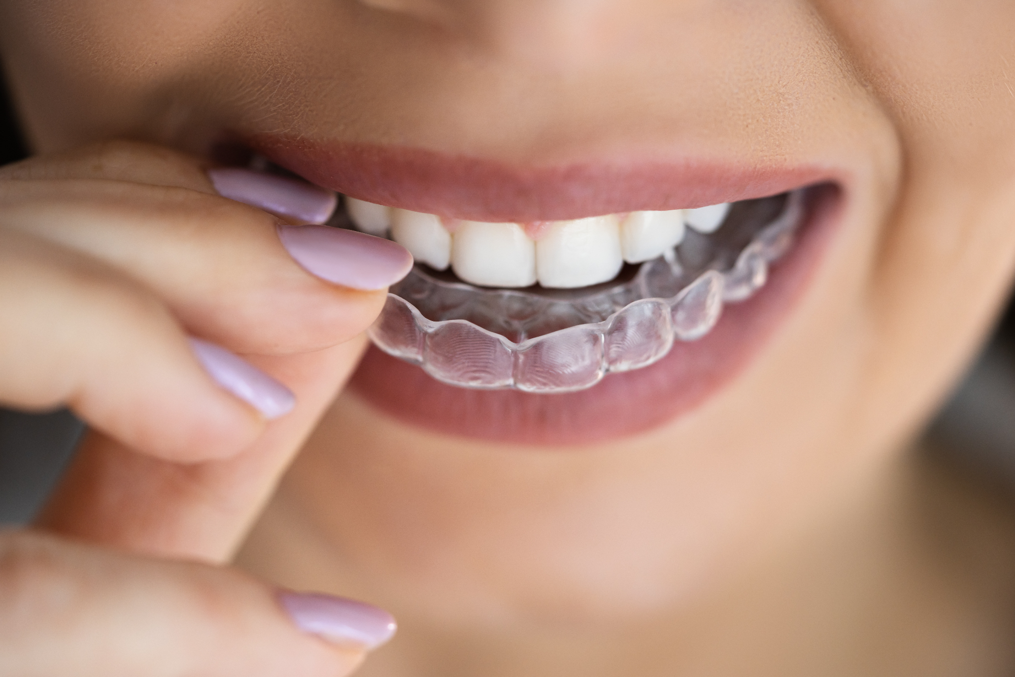 Najbolj učinkovit je Invisalign zobni aparat